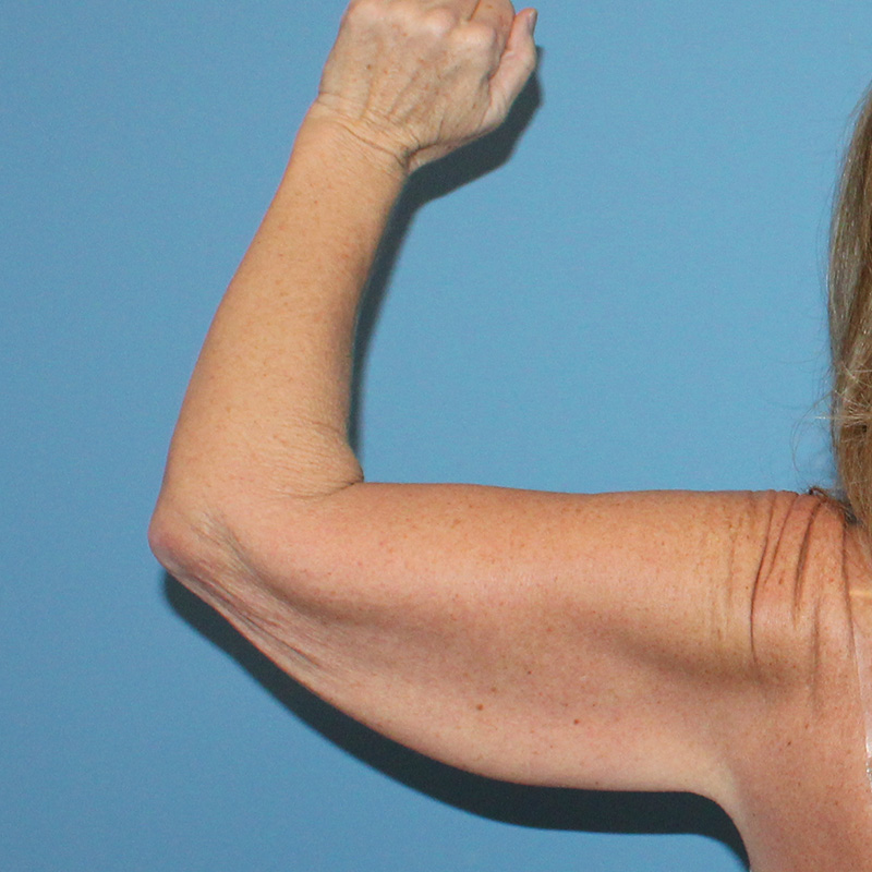 Arm Lift Before and After | SGK Plastic Surgery
