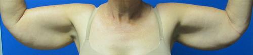 Arm Lift Before and After | SGK Plastic Surgery