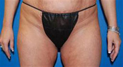 Liposuction in The Woodlands, TX