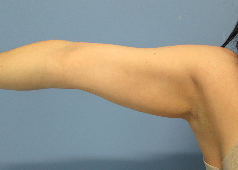 Liposuction Before and After | SGK Plastic Surgery