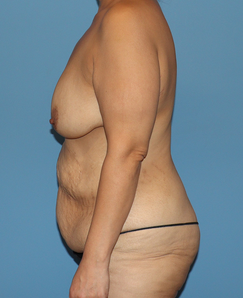 Tummy Tuck Before and After | SGK Plastic Surgery