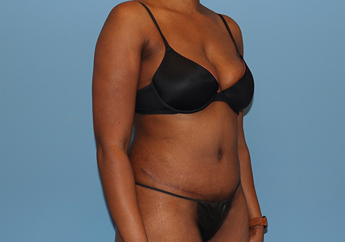 Tummy Tuck Before and After | SGK Plastic Surgery
