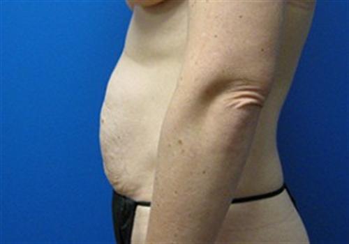 Tummy Tuck Before and After | SGK Plastic Surgery