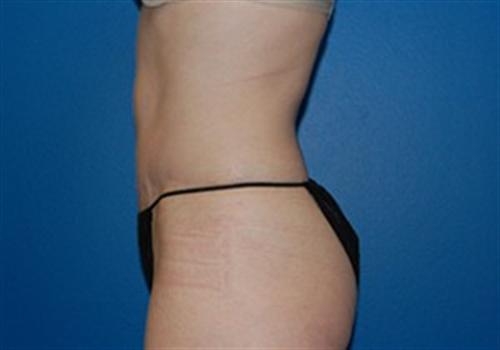 Tummy Tuck Before and After | SGK Plastic Surgery