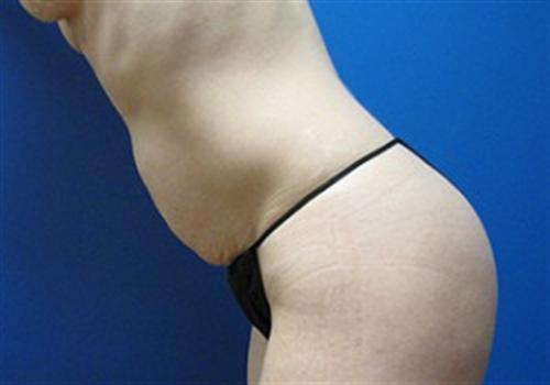 Tummy Tuck Before and After | SGK Plastic Surgery