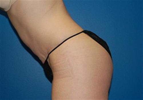 Tummy Tuck Before and After | SGK Plastic Surgery