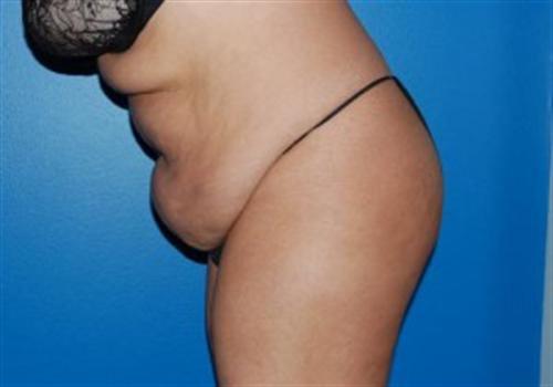 Tummy Tuck Before and After | SGK Plastic Surgery