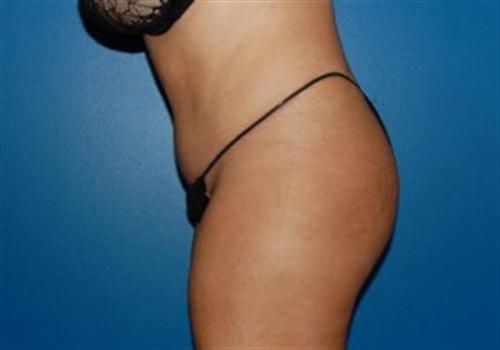 Tummy Tuck Before and After | SGK Plastic Surgery