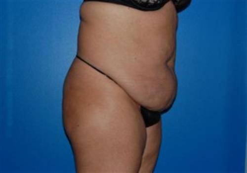 Tummy Tuck Before and After | SGK Plastic Surgery