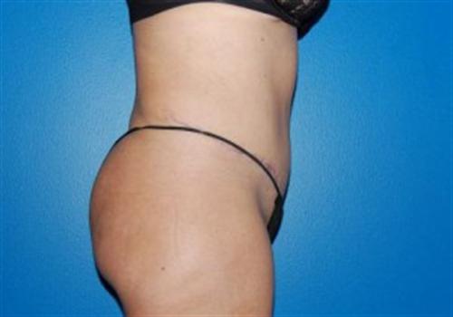 Tummy Tuck Before and After | SGK Plastic Surgery