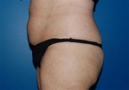 Tummy Tuck Before and After | SGK Plastic Surgery