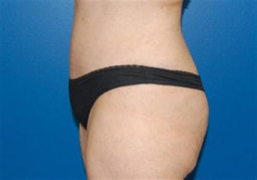 Tummy Tuck Before and After | SGK Plastic Surgery