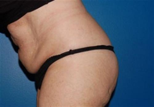 Tummy Tuck Before and After | SGK Plastic Surgery