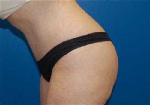 Tummy Tuck Before and After | SGK Plastic Surgery
