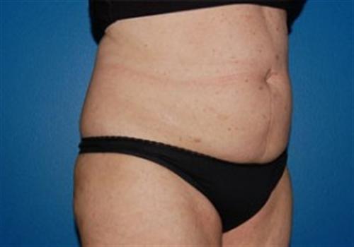 Tummy Tuck Before and After | SGK Plastic Surgery