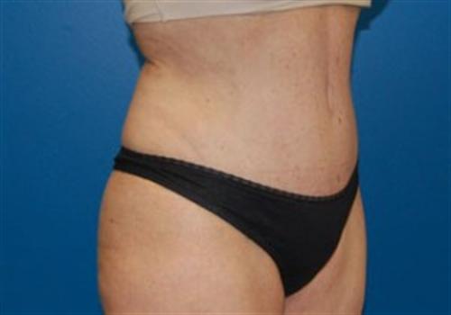 Tummy Tuck Before and After | SGK Plastic Surgery