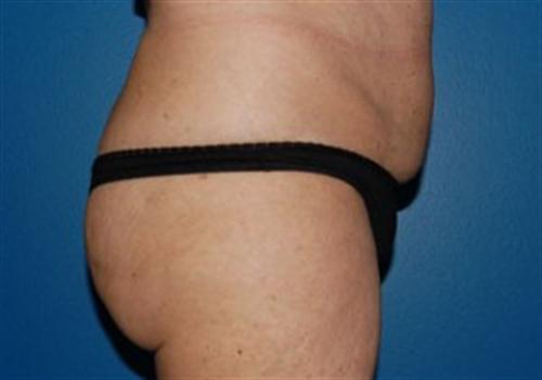 Tummy Tuck Before and After | SGK Plastic Surgery