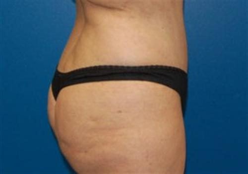 Tummy Tuck Before and After | SGK Plastic Surgery