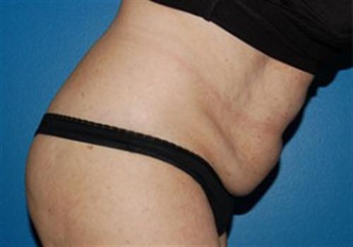 Tummy Tuck Before and After | SGK Plastic Surgery
