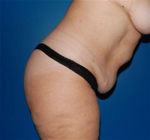 Tummy Tuck Before and After | SGK Plastic Surgery