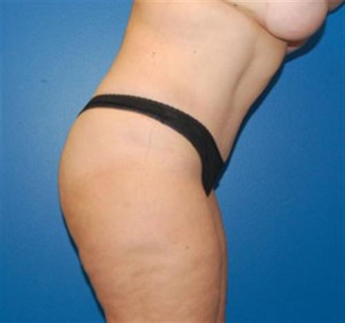 Tummy Tuck Before and After | SGK Plastic Surgery