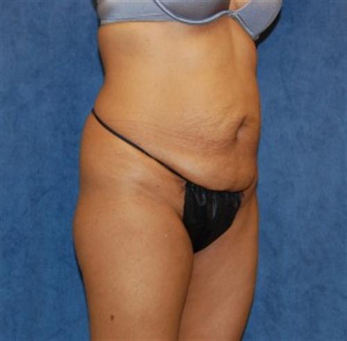 Tummy Tuck Before and After | SGK Plastic Surgery