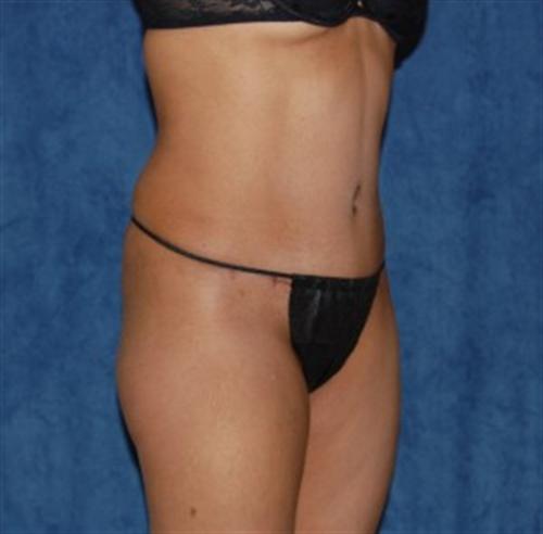 Tummy Tuck Before and After | SGK Plastic Surgery