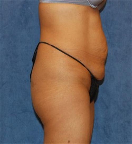 Tummy Tuck Before and After | SGK Plastic Surgery