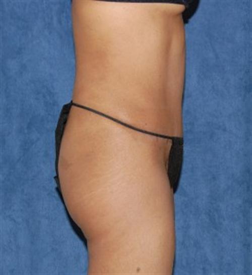 Tummy Tuck Before and After | SGK Plastic Surgery