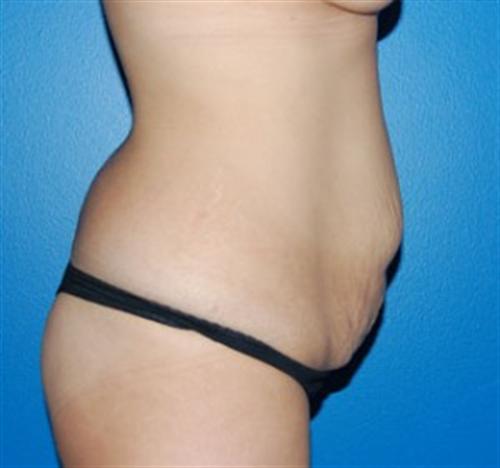 Tummy Tuck Before and After | SGK Plastic Surgery