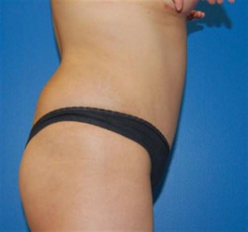 Tummy Tuck Before and After | SGK Plastic Surgery