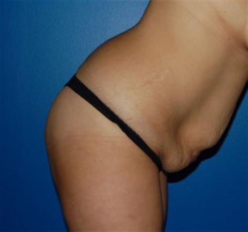 Tummy Tuck Before and After | SGK Plastic Surgery