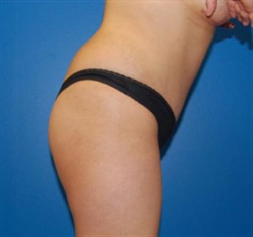 Tummy Tuck Before and After | SGK Plastic Surgery