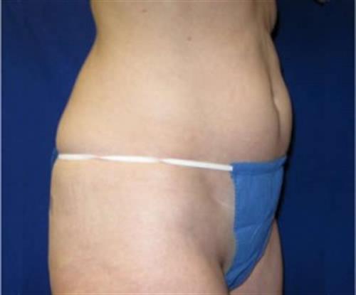 Tummy Tuck Before and After | SGK Plastic Surgery