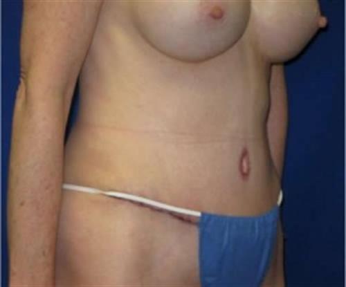 Tummy Tuck Before and After | SGK Plastic Surgery