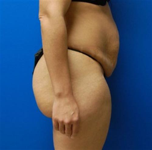 Tummy Tuck Before and After | SGK Plastic Surgery