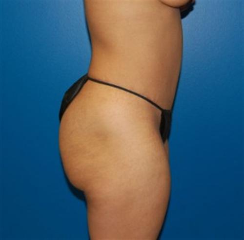 Tummy Tuck Before and After | SGK Plastic Surgery