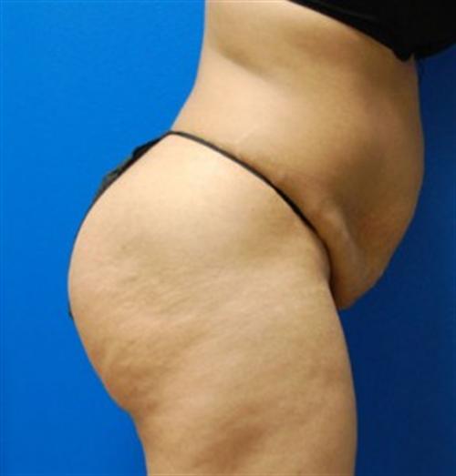 Tummy Tuck Before and After | SGK Plastic Surgery