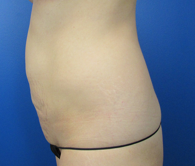 Tummy Tuck Before and After | SGK Plastic Surgery