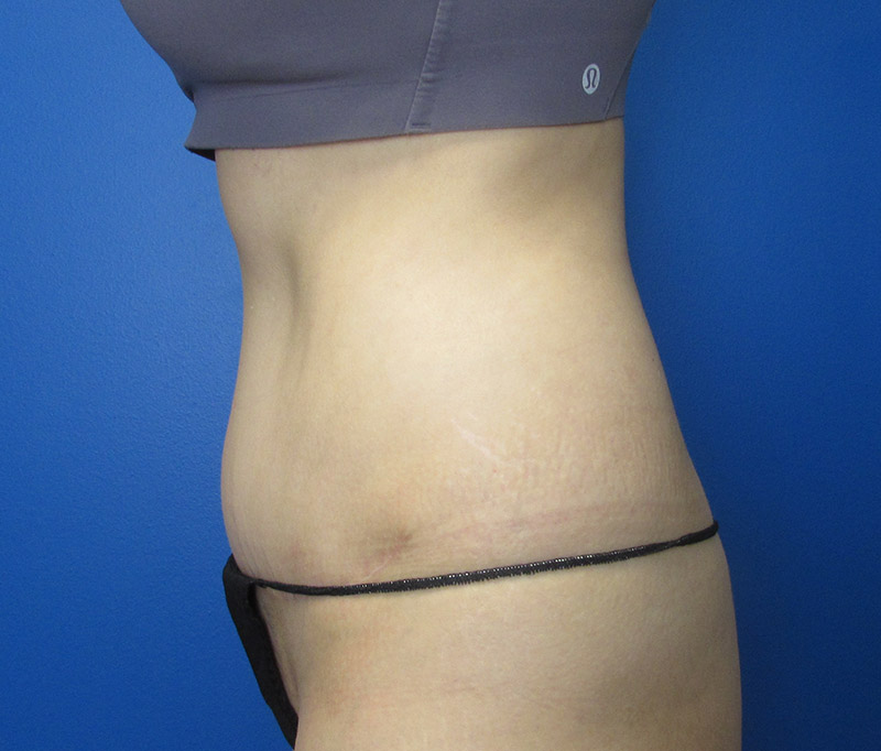 Tummy Tuck Before and After | SGK Plastic Surgery