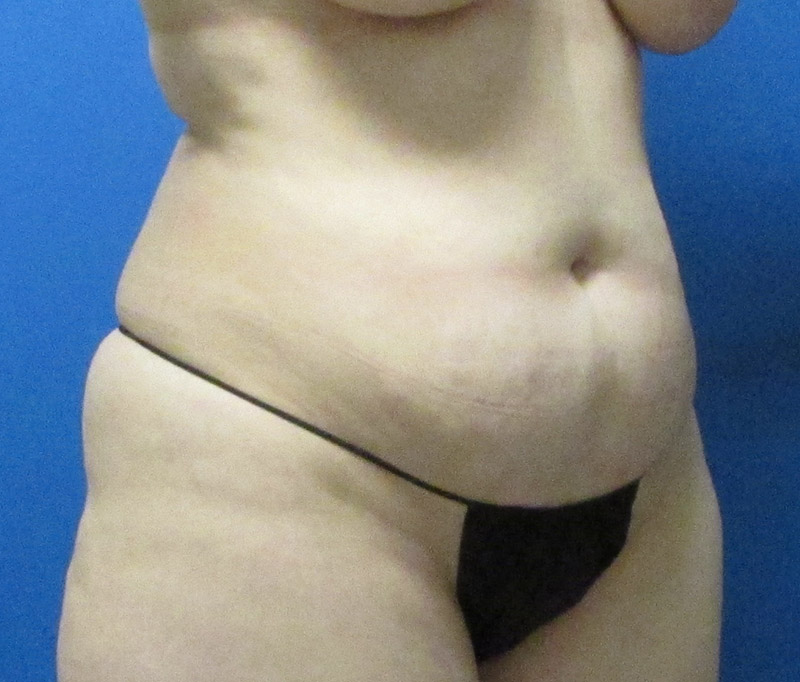 Tummy Tuck Before and After | SGK Plastic Surgery