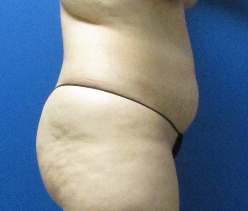 Tummy Tuck Before and After | SGK Plastic Surgery