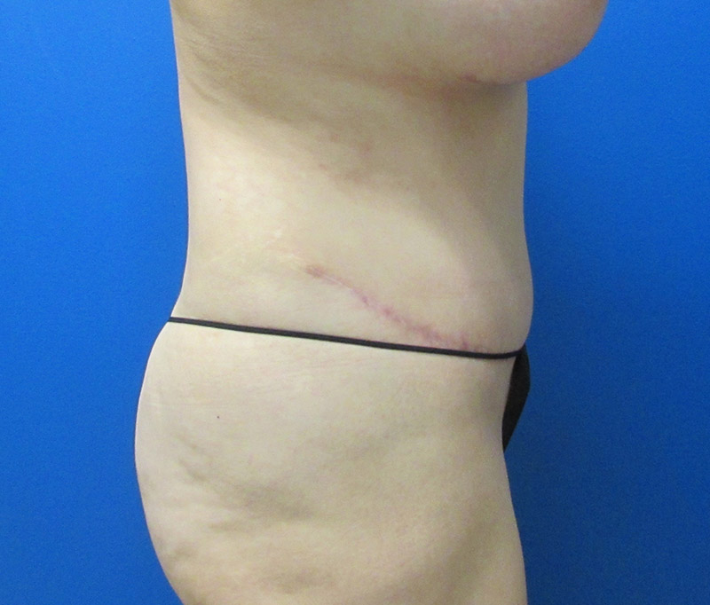 Tummy Tuck Before and After | SGK Plastic Surgery