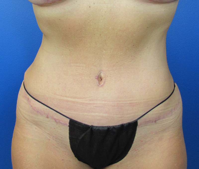 Tummy Tuck Before and After | SGK Plastic Surgery