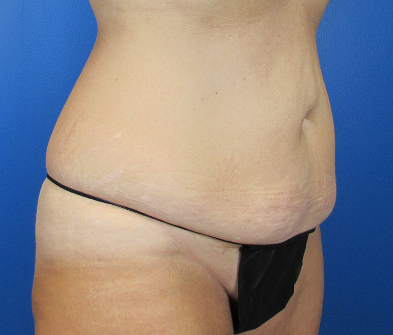 Tummy Tuck Before and After | SGK Plastic Surgery
