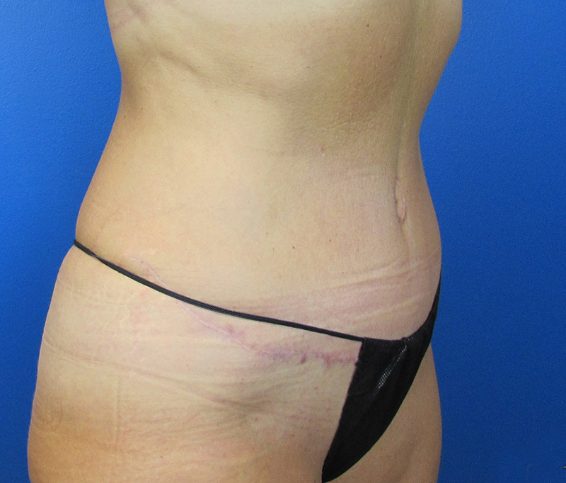 Tummy Tuck Before and After | SGK Plastic Surgery