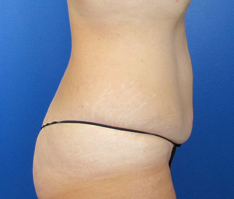 Tummy Tuck Before and After | SGK Plastic Surgery