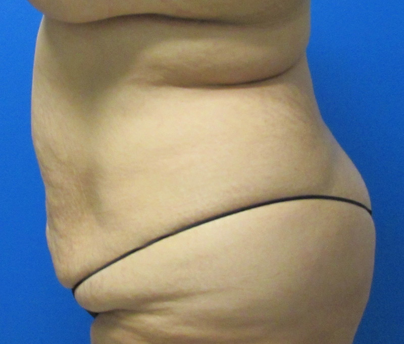 Tummy Tuck Before and After | SGK Plastic Surgery