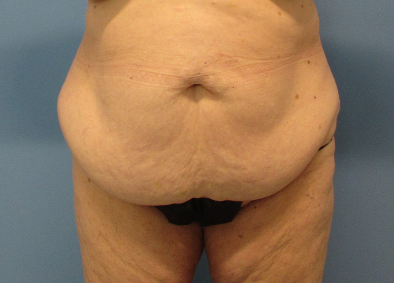 Tummy Tuck Before and After | SGK Plastic Surgery