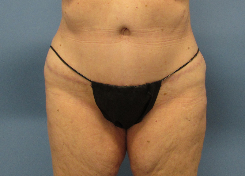 Tummy Tuck Before and After | SGK Plastic Surgery